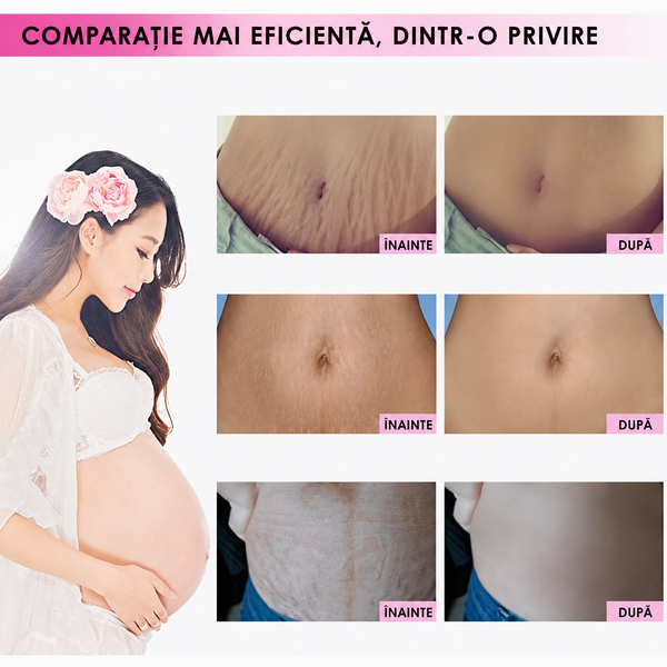 Cremă Minune pentru Vergeturi